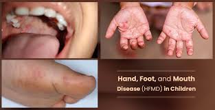 St. Mary’s County Reports Increased Levels of Hand, Foot, and Mouth Disease